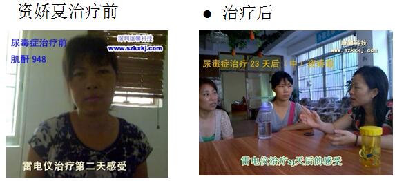 ECT雷电电摩治疗尿毒症